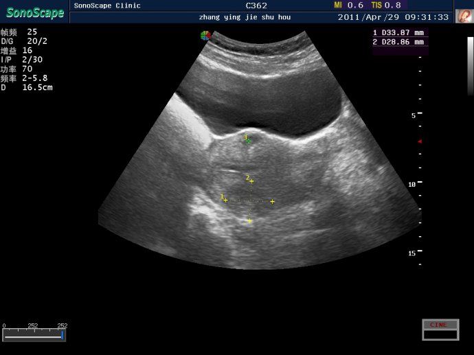 子宫肌瘤超声消融治疗效果图(三)