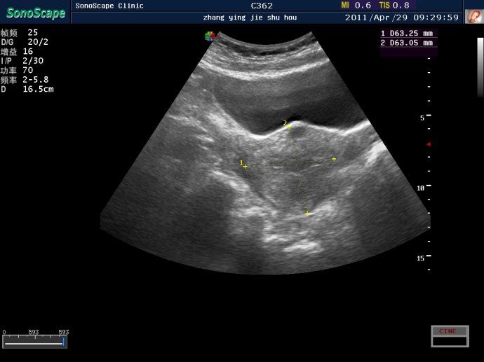 子宫肌瘤超声消融治疗效果图(三)
