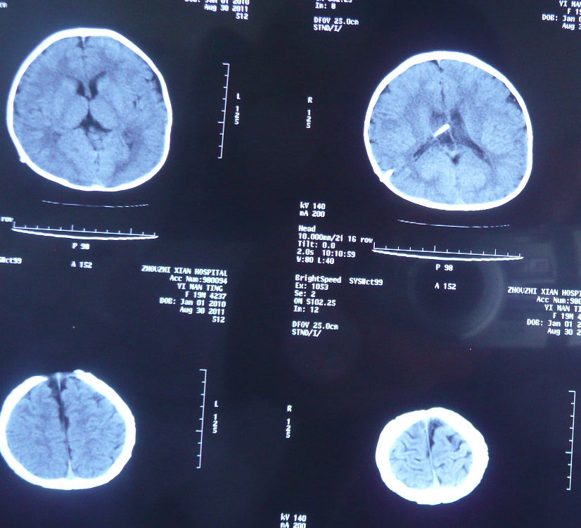 儿童脑积水治疗实例(多图)