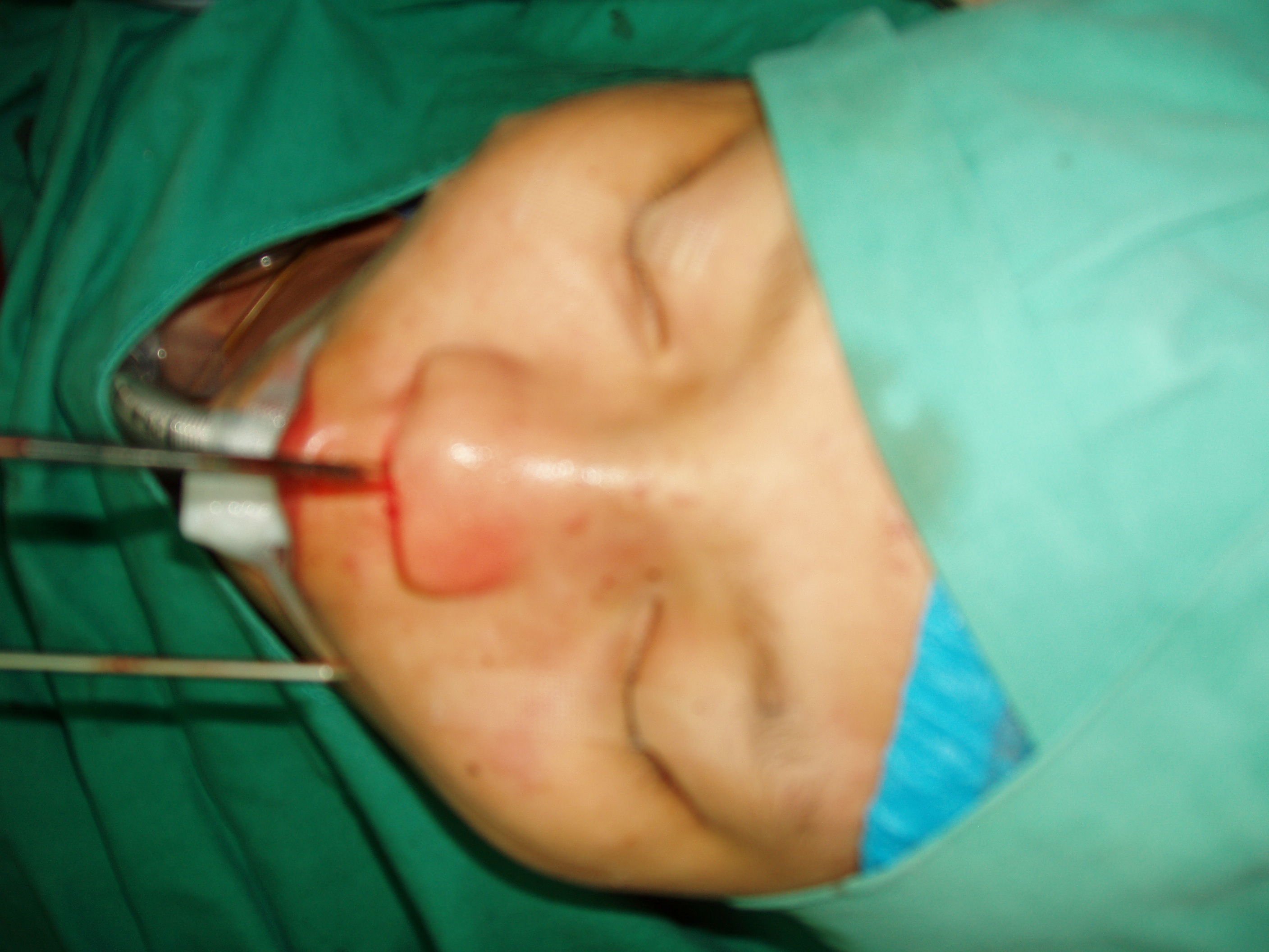 鼻内镜下的鼻骨骨瘤手术