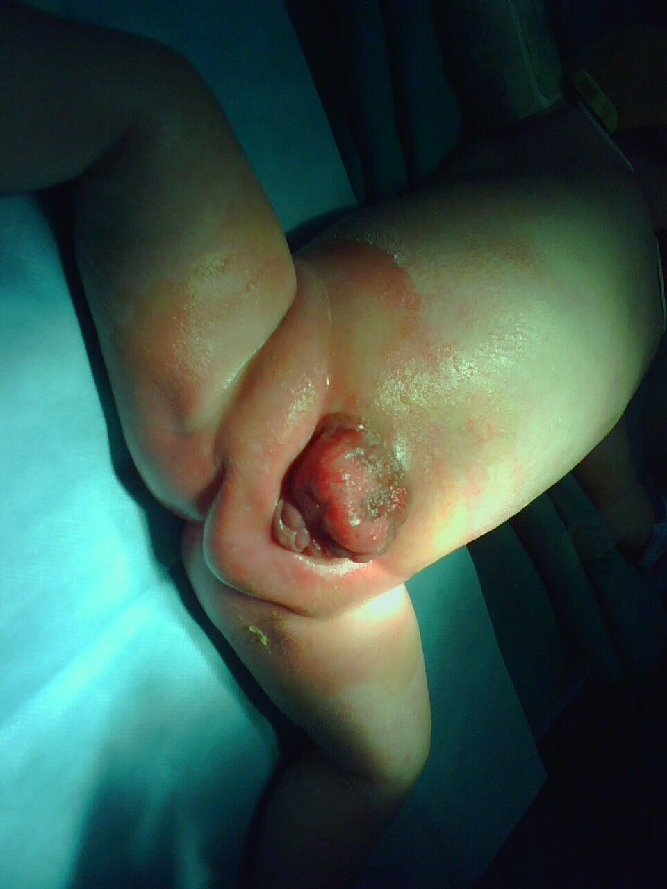 下图为一男性尿道上裂合并膀胱外翻,即为完全性的尿道上裂.