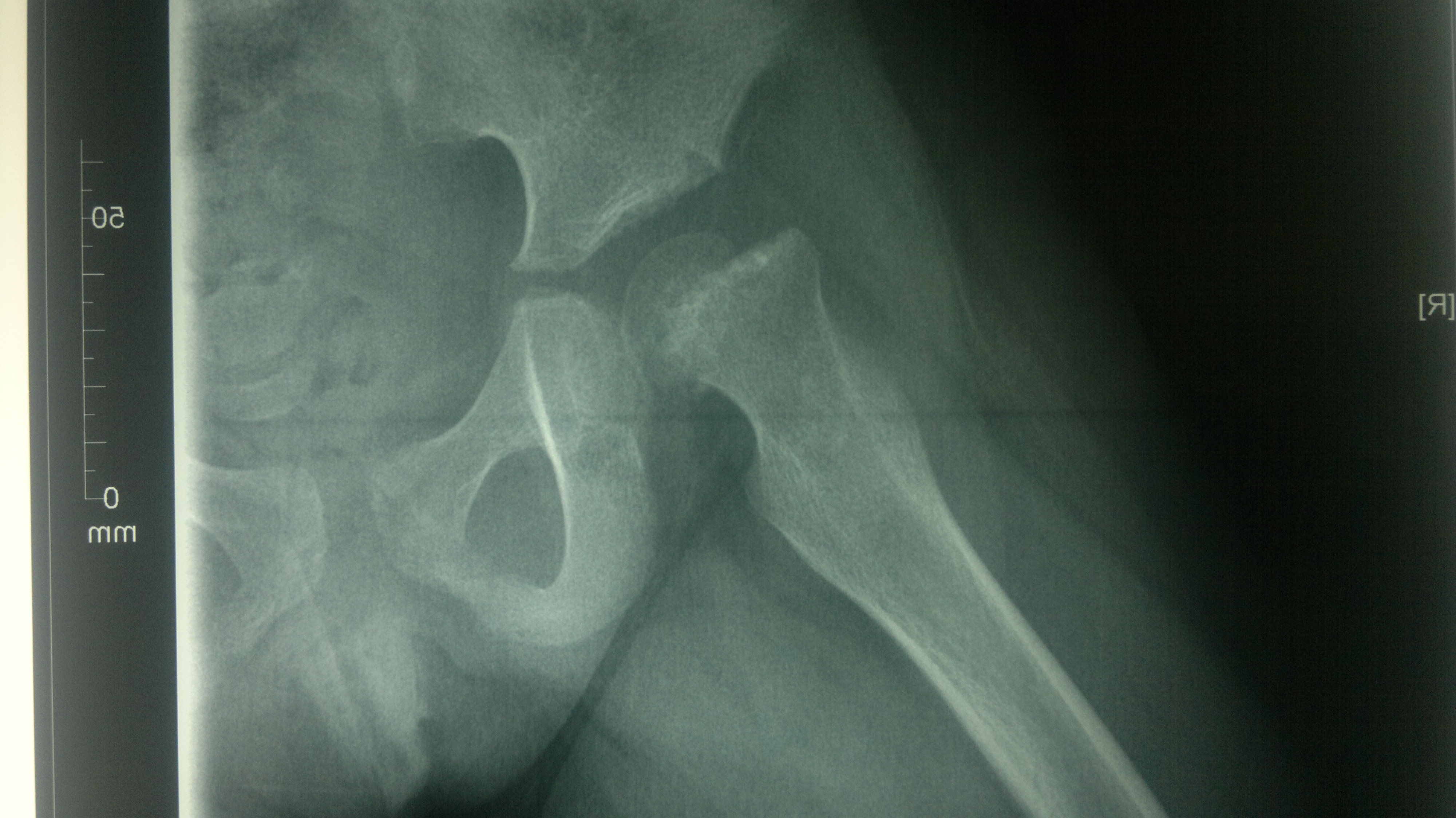 6岁患儿股骨头骨骺完全分离----进一步随访中.