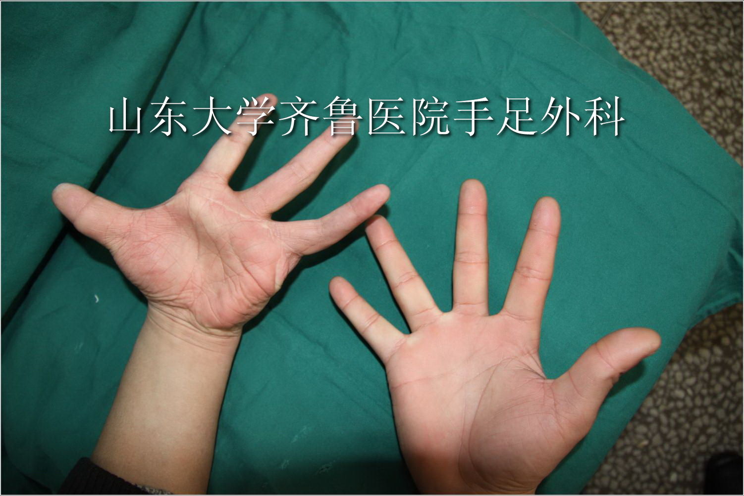 手外伤早期治疗_手外伤_治疗方法_治疗方式- 好大夫在线