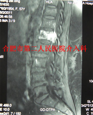 椎体血管瘤介入治疗 好大夫在线