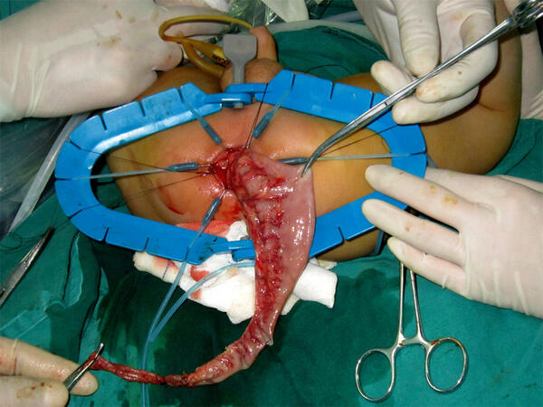 经自然腔道腹腔镜辅助巨结肠根治术