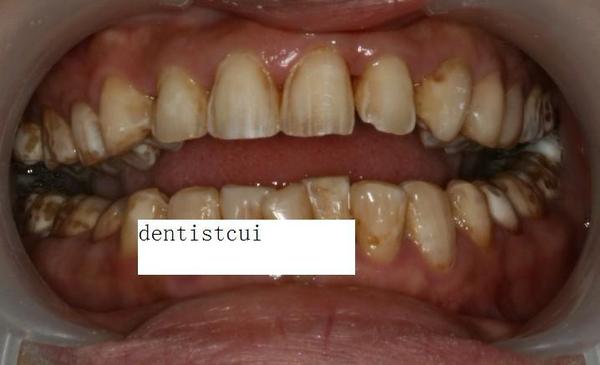 全瓷贴面修复氟斑牙