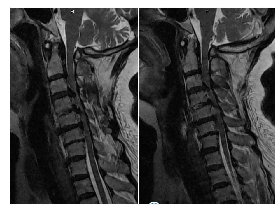 骨化 韧带 严重/术前CT及MRI可以发现巨大的后纵韧带骨化物造成及其严重的脊髓...