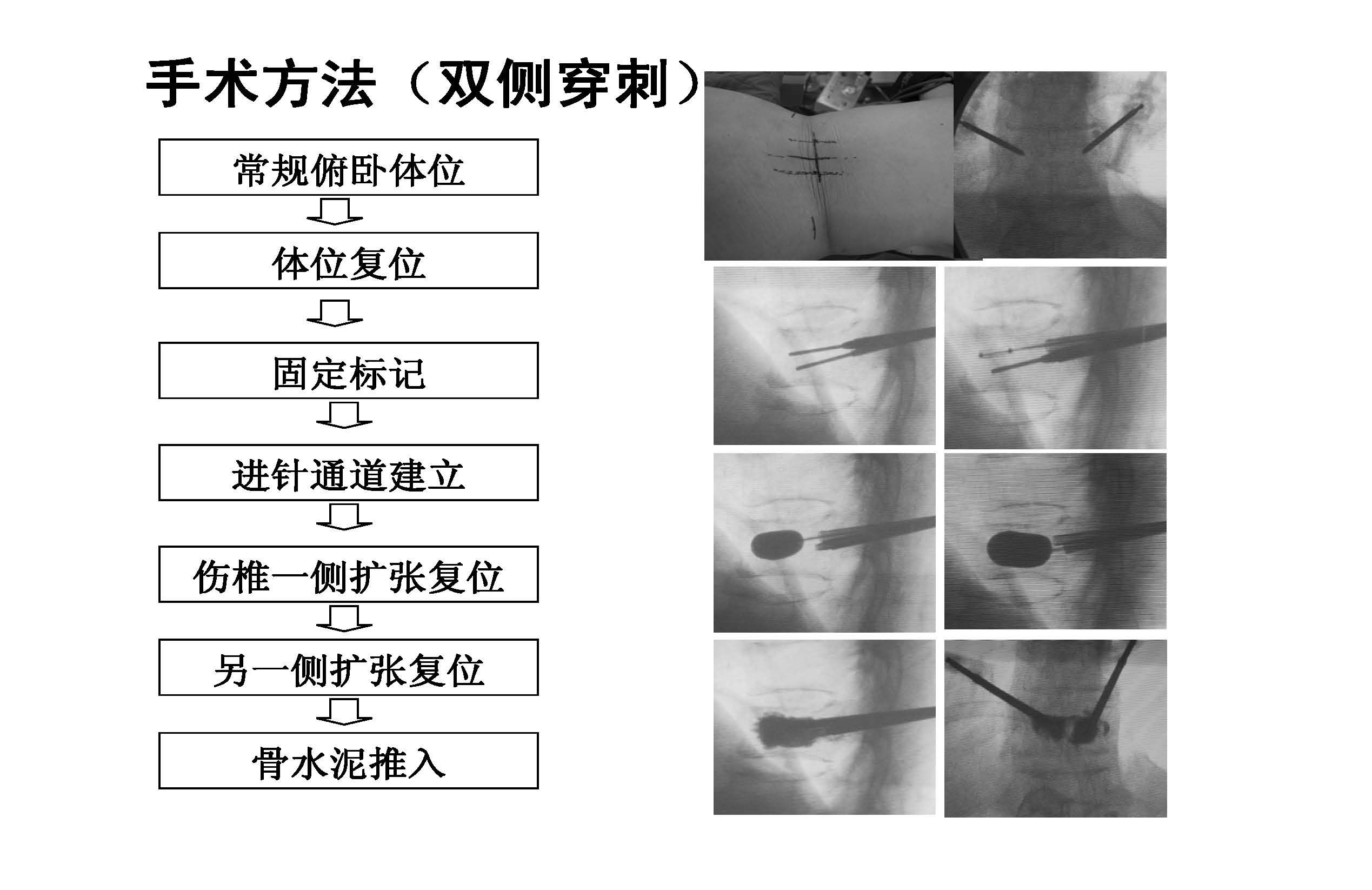 老年骨质疏松型椎体骨折的pkp微创手术的临床疗效