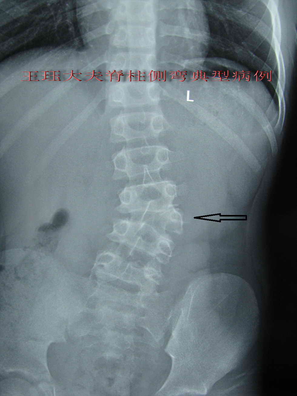 患者:男,11岁,先天性脊柱侧弯----腰终于挺直了.