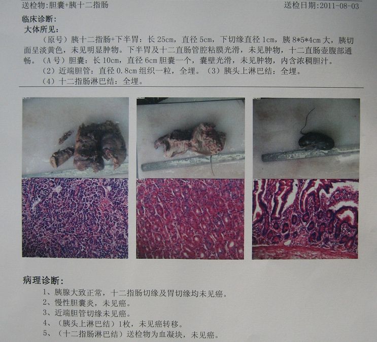 57岁,男性, 胆管癌 行胰十二指肠切除术,已生存6年6个月.仍在随访中.