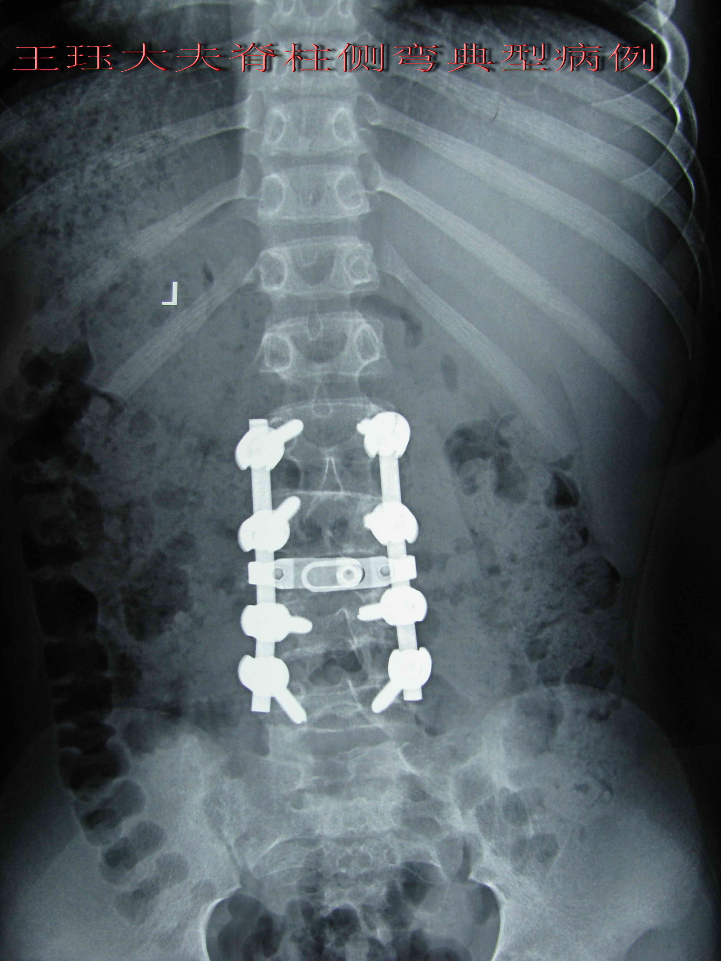 患者:男,11岁,先天性脊柱侧弯----腰终于挺直了.