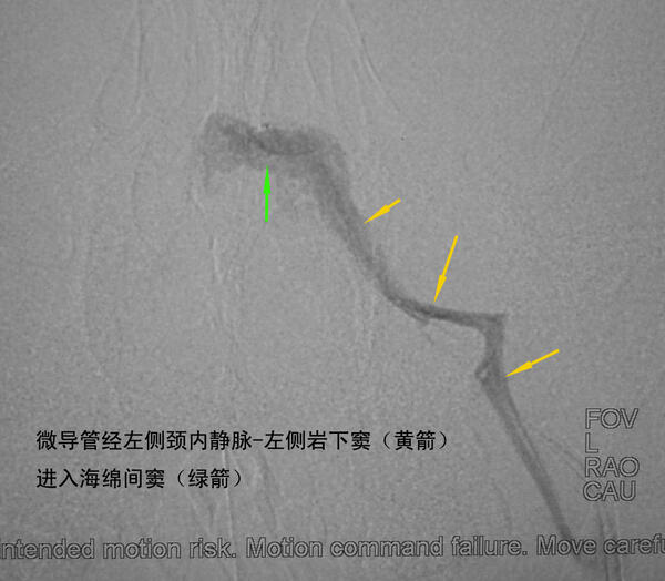 海绵窦区硬脑膜动静脉瘘双侧岩下窦入路闭塞瘘口