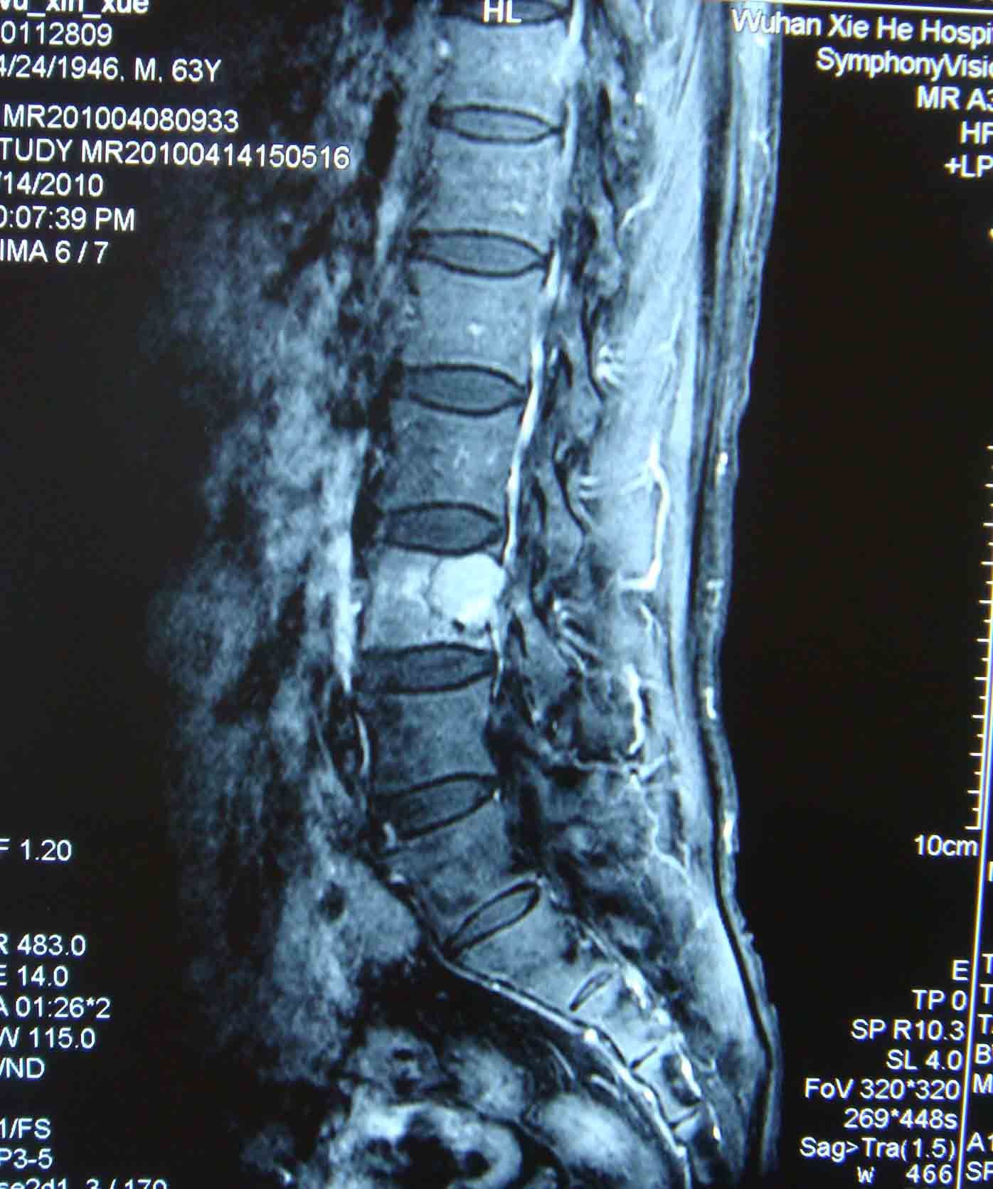 脊柱肿瘤典型病例(三)