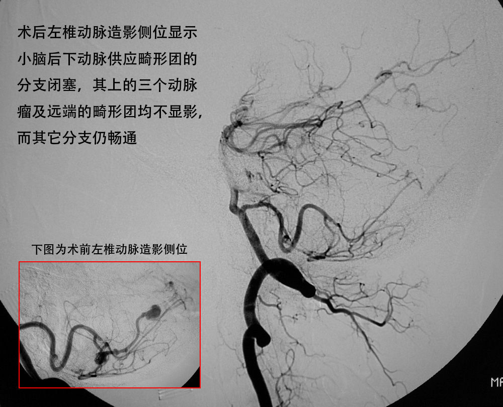 所有病变血管(畸形团)一网打尽,又不至于累及正常血管或逸入静脉远端