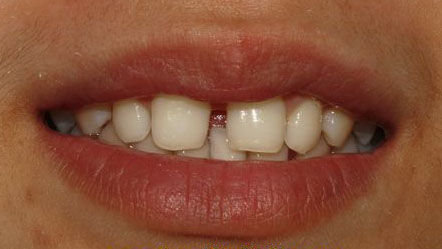 患者因"上前牙缝隙过大,不愿接受正畸治疗.