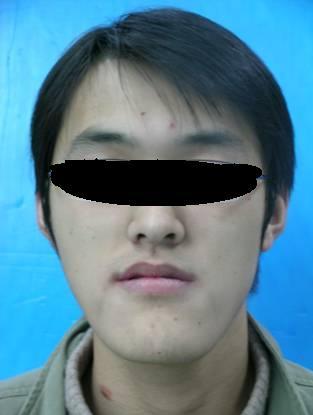 旧貌换新颜—正颌外科技术矫正牙颌面畸形