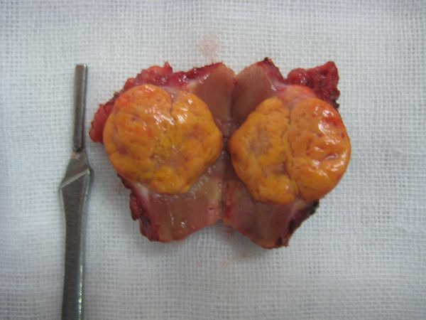 典型病例9-左肾肿瘤肾部分切除(保留肾单位手