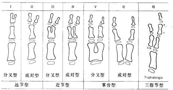 拇指多指畸形的wassel分型