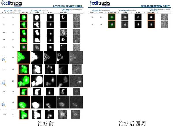 肿瘤光动力学免疫治疗案例 - 好大夫在线