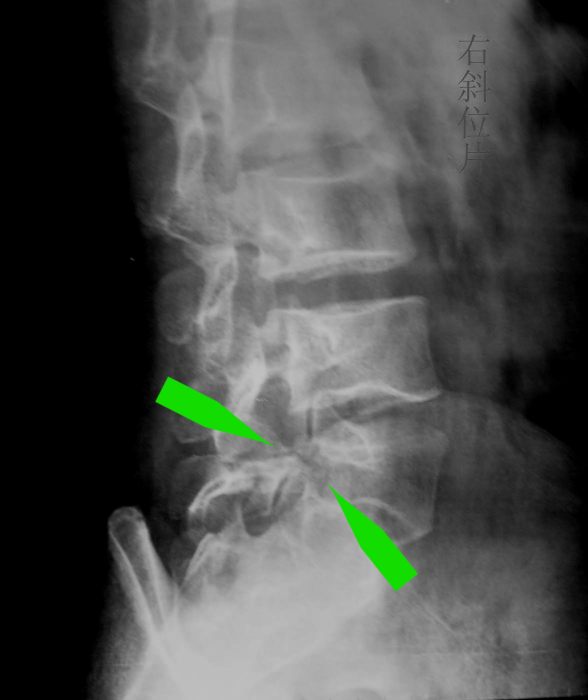 由于腰椎峡部崩裂所引起的腰椎滑脱称为腰椎真性滑脱,峡部崩裂的原因