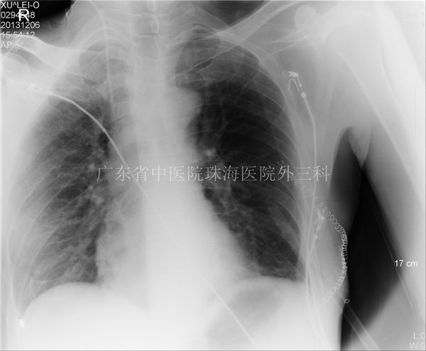 外伤嵌顿性膈疝救治案例