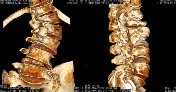 术前腰椎片示: 脊柱侧弯 ,旋转,正位棘突不正,侧位椎间隙界线不