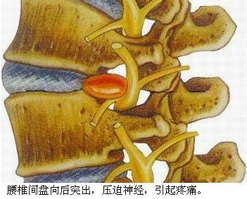 腰肌劳损还是腰椎间盘突出?