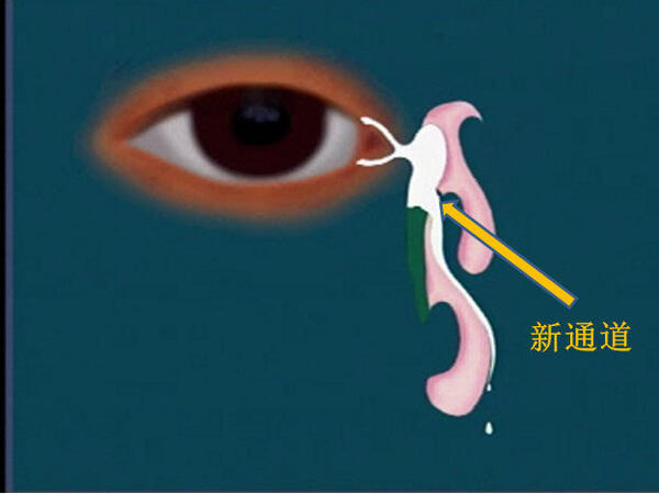 什么是经鼻泪囊鼻腔造口术