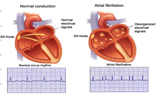 读懂房颤患者的心电图