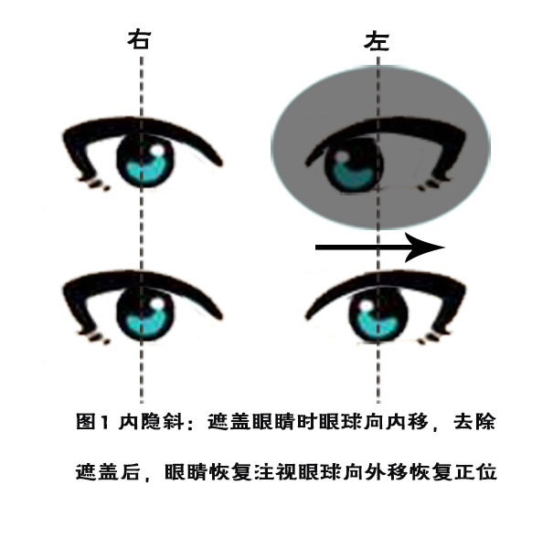 遮盖法查斜视,主要观察眼球动不动