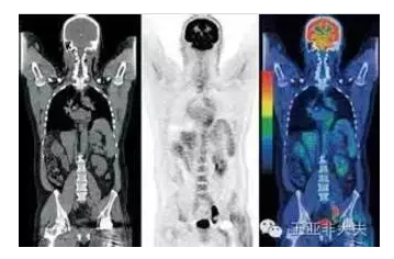 查些什么?_多发性骨髓瘤_多发性骨髓瘤检查 -