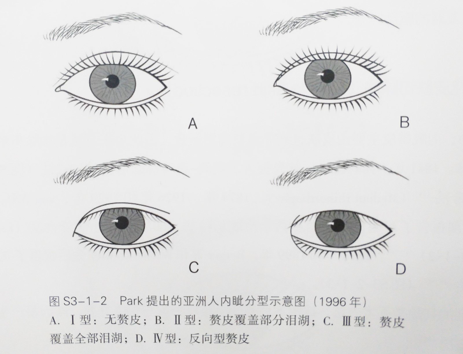 内眦赘皮有哪几种分类方法?