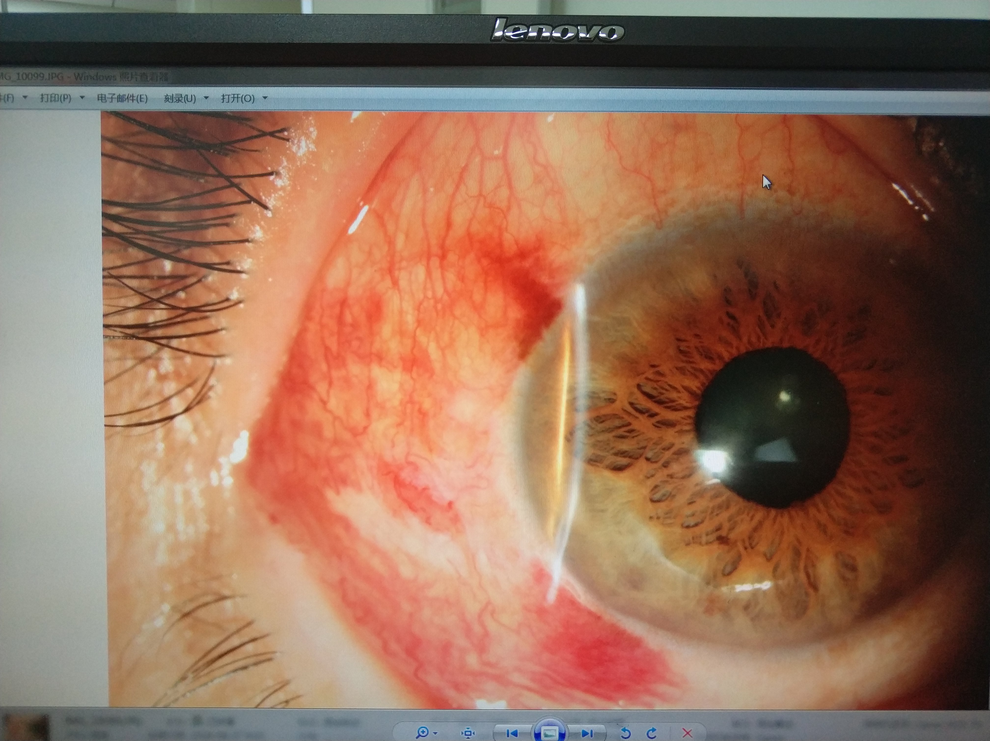 Pterygium Eye Disease