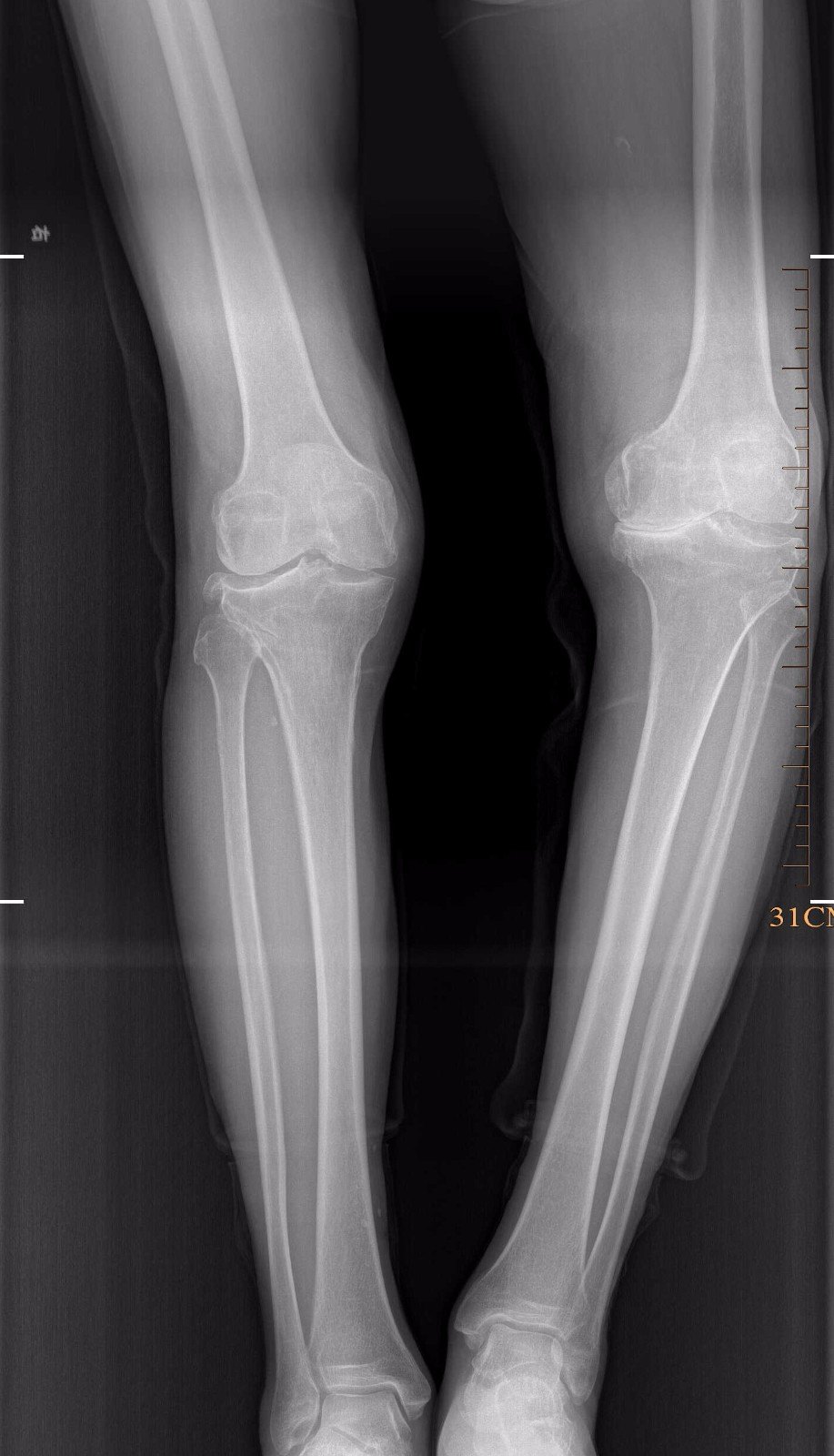 膝关节内翻合并膝骨 关节炎 x线片