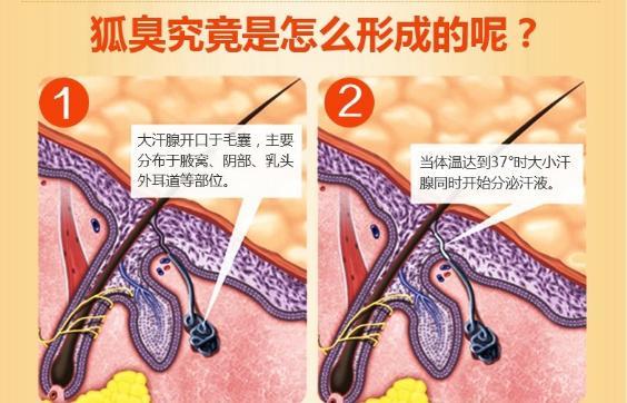 腋臭俗称狐臭 ,是分布在体表皮肤如腋下,会阴,背上部位的大汗腺分泌