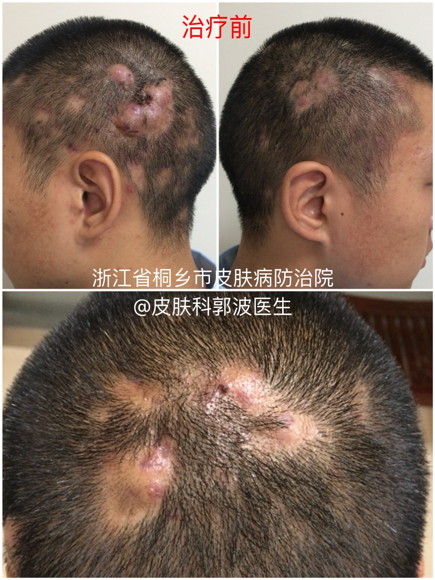 临床病例展示:头部脓肿性穿凿性毛囊周围炎