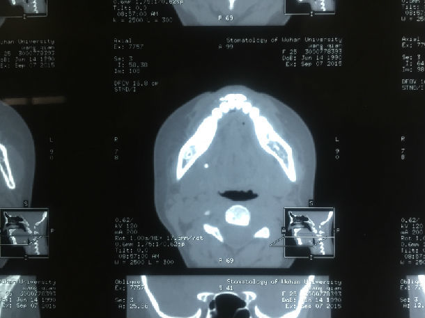 术后术前片刘某,男,36岁,右侧颌下腺导管结石,ct片可见右侧口底前份