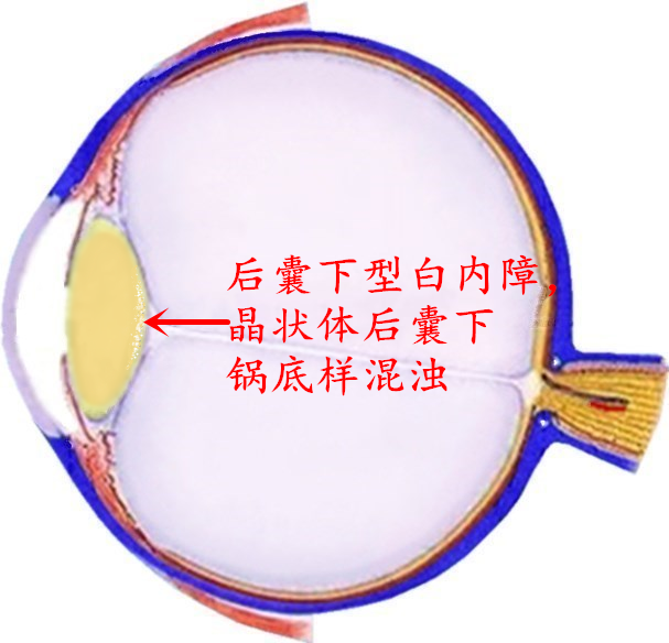 人人都避不开的白内障