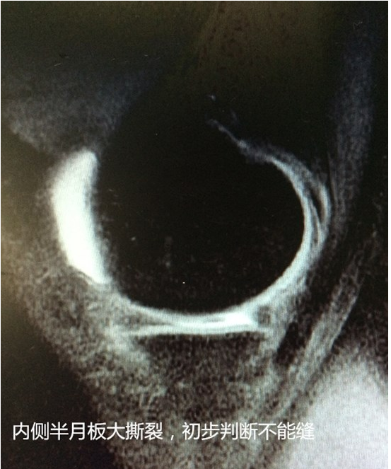 1前交叉韧带股骨端撕裂,拟行自体肌腱移植重建;2内侧半月板损伤,桶柄