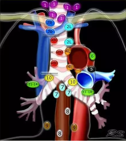 肺癌淋巴结一览图各站淋巴结详解锁骨上区淋巴结(1)和上气管旁淋巴结