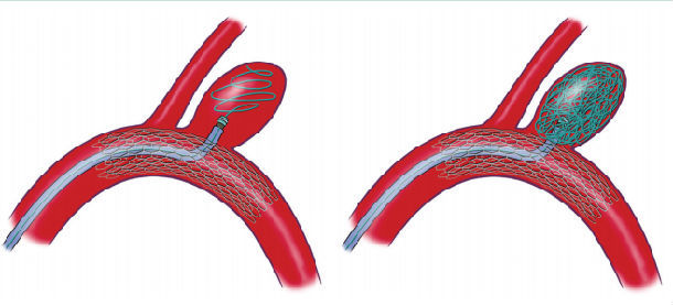 支架辅助动脉瘤栓塞术