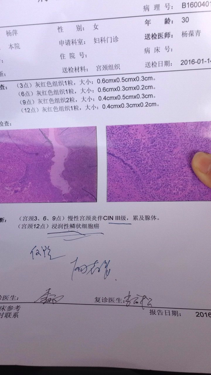 宫颈癌可以保留子宫吗?