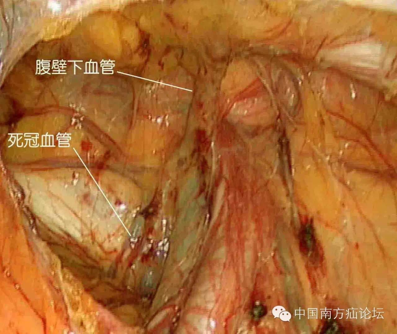 基础腔镜下腹股沟解剖三危险与坑