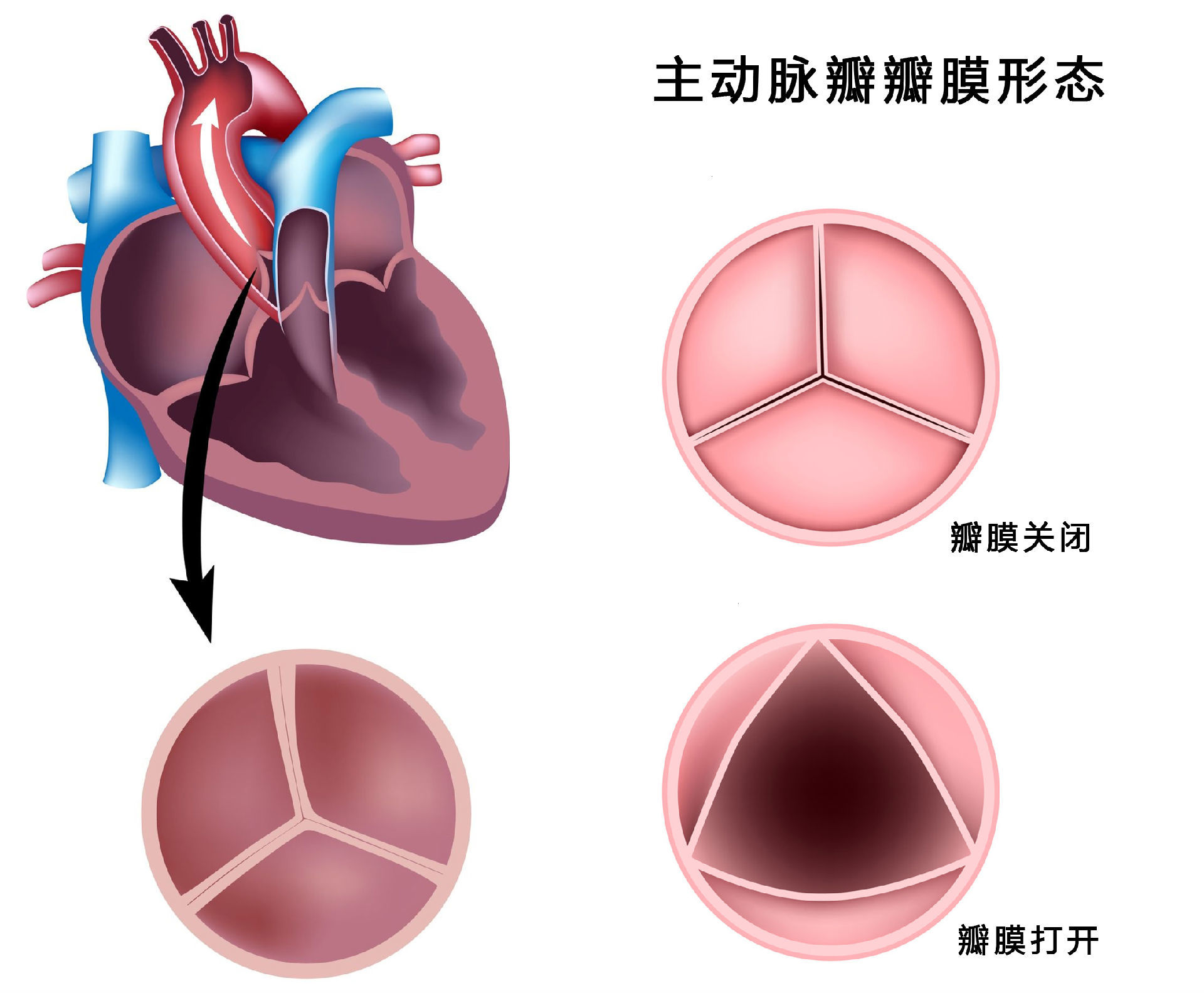 同样是室缺,为什么有的会引起主动脉瓣脱垂,返流_心脏瓣膜性疾病_心脏