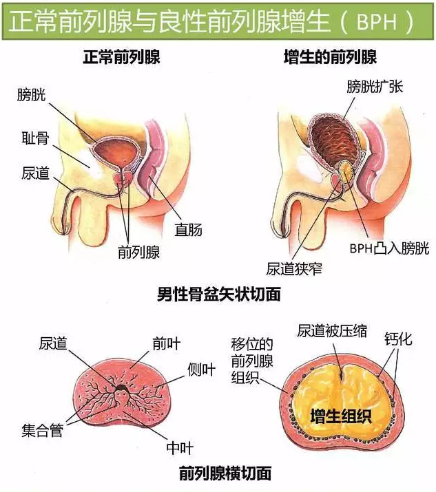 一张图系列良性前列腺增生啥东东