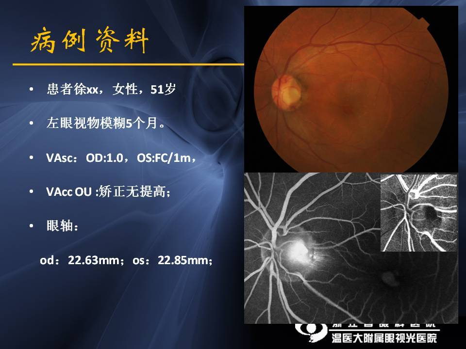 视盘小凹相关黄斑疾病