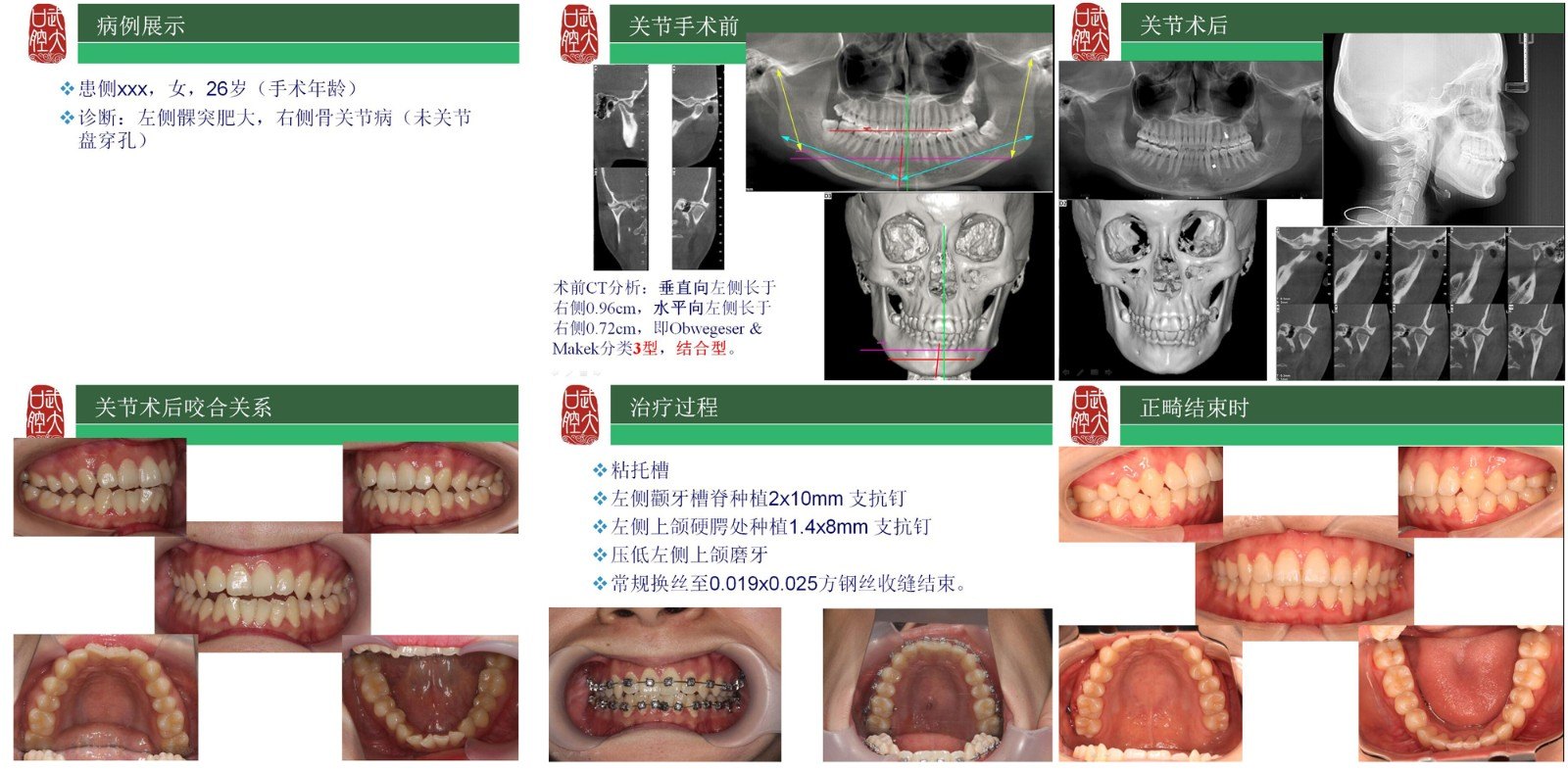 治疗单侧髁突肥大(偏颌畸形),您愿意选哪种方式?_牙颌