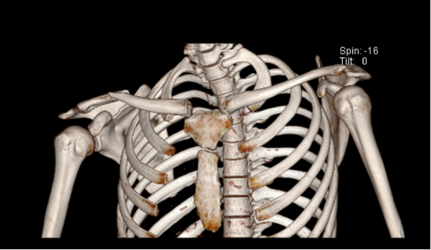 术前x线:右锁骨 骨折 术前ct三维重建:可以清晰显示 骨折 断端情况