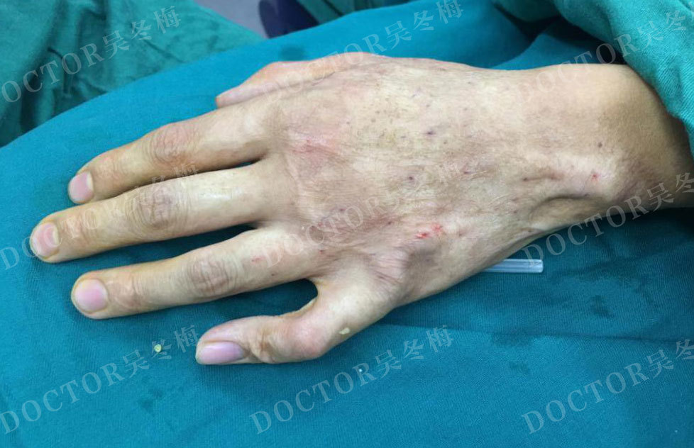 瘢痕治疗新疗法自体脂肪移植治疗瘢痕