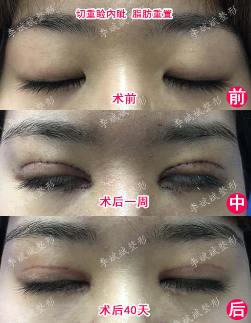 李斌斌手术实例双眼皮恢复过程三